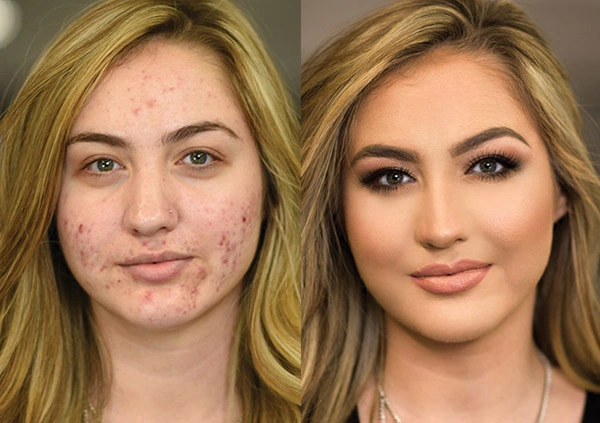Giới trẻ thường xử lý tình huống che mụn bằng phấn trang điểm không quan tâm.